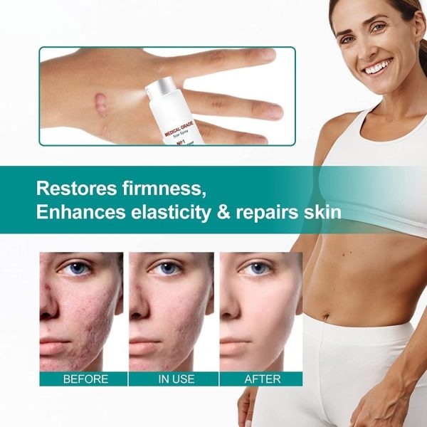 Scar Remove,scar Remove Medical Grade Scar Spray,medical Grade Scar Removal Spray,scar Removal Spray,scar Remove Spray,scar Spray,advanced Acne Scar Treatment For Face (1pcs)