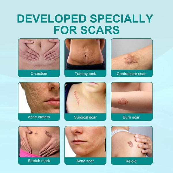 Scar Remove,scar Remove Medical Grade Scar Spray,medical Grade Scar Removal Spray,scar Removal Spray,scar Remove Spray,scar Spray,advanced Acne Scar Treatment For Face (1pcs)