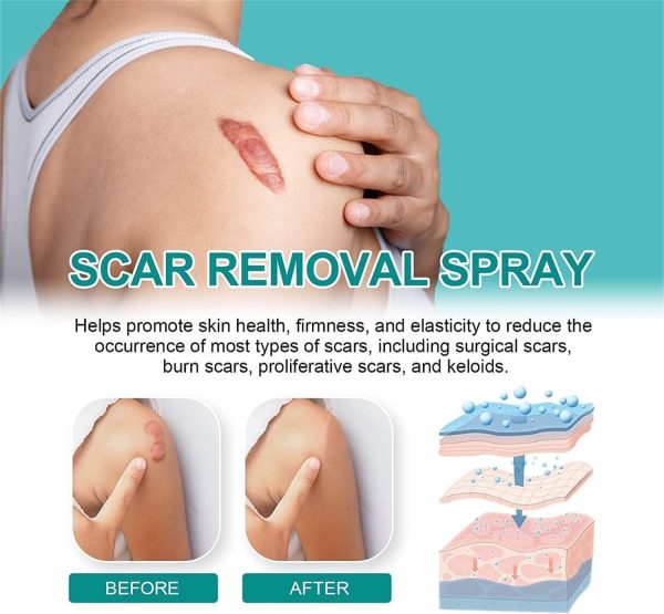 Scar Remove,scar Remove Medical Grade Scar Spray,medical Grade Scar Removal Spray,scar Removal Spray,scar Remove Spray,scar Spray,advanced Acne Scar Treatment For Face (1pcs)